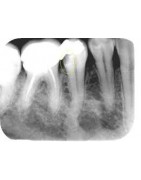 Varios endodoncia